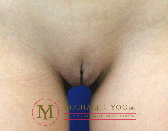Labiaplasty Before & After Patient #2263
