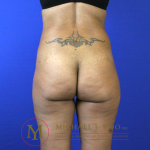 Brazilian Butt Lift Before & After Patient #2251