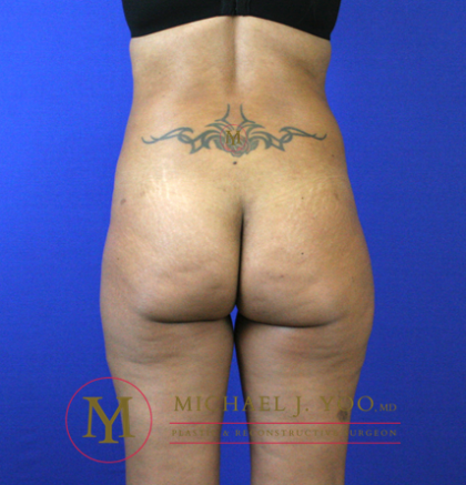 Brazilian Butt Lift Before & After Patient #2251