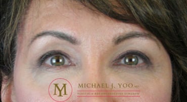 Upper Eyelid Lift Before & After Patient #2321