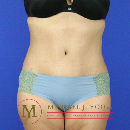 Tummy Tuck Before & After Patient #2311