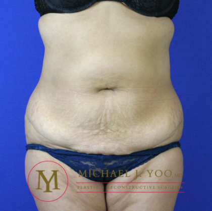 Tummy Tuck Before & After Patient #2311