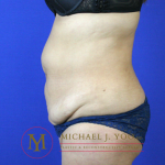 Tummy Tuck Before & After Patient #2311