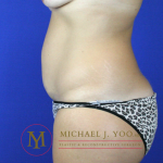 Tummy Tuck Before & After Patient #2302