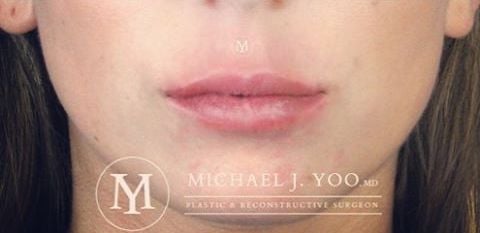 Fillers Before & After Patient #2334