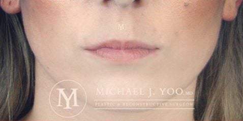 Fillers Before & After Patient #2334