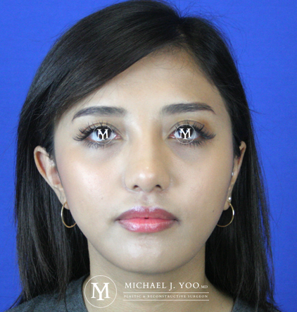 Fillers Before & After Patient #2329