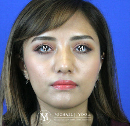 Fillers Before & After Patient #2329