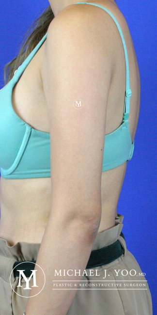 Arm Liposuction Before & After Patient #2417