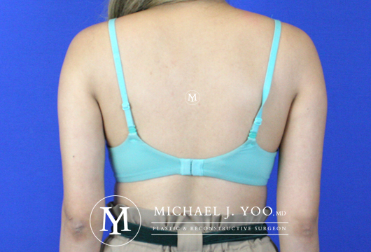 Arm Liposuction Before & After Patient #2417