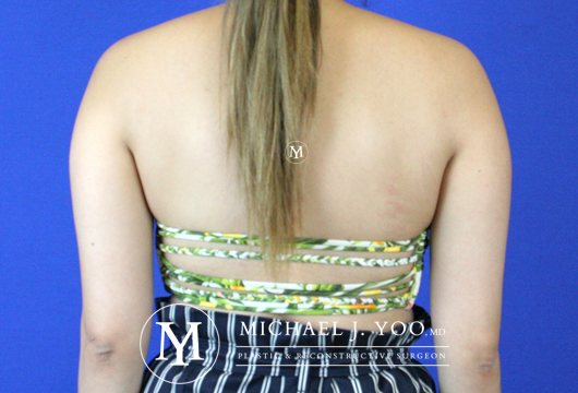 Arm Liposuction Before & After Patient #2417