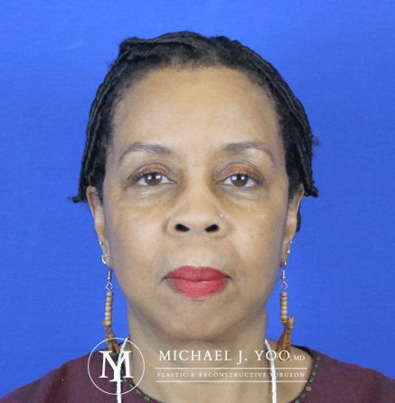 Facelift & Neck Lift Before & After Patient #2437