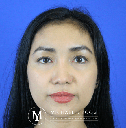 Fillers Before & After Patient #2447