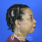 Facelift & Neck Lift Before & After Patient #2437