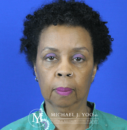 Facelift & Neck Lift Before & After Patient #2437