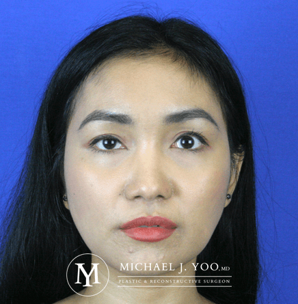 Fillers Before & After Patient #2447