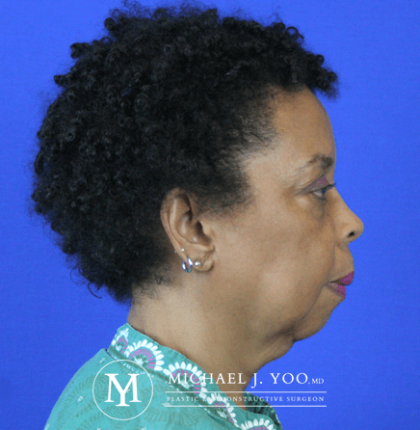 Facelift & Neck Lift Before & After Patient #2437