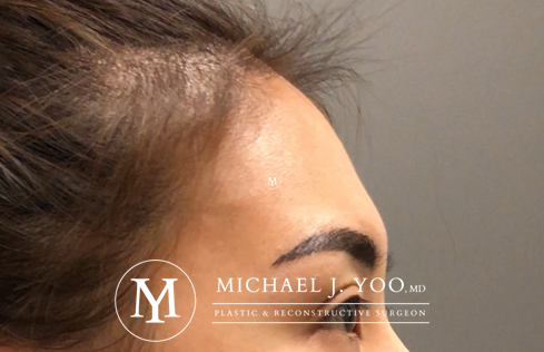 Fillers Before & After Patient #2457