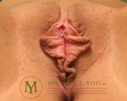 Labiaplasty Before & After Patient #2512
