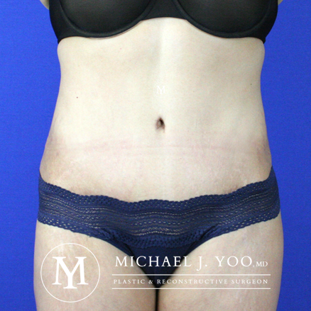 Tummy Tuck Before & After Patient #2515