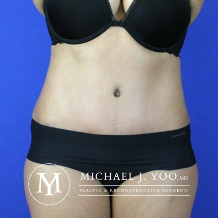 Tummy Tuck Before & After Patient #2507