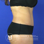 Tummy Tuck Before & After Patient #2507
