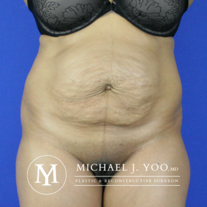 Tummy Tuck Before & After Patient #2507