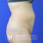 Tummy Tuck Before & After Patient #2515