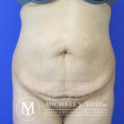 Tummy Tuck Before & After Patient #2515