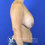 Breast Lift with Implants Before & After Patient #2524