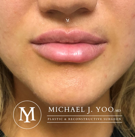 Fillers Before & After Patient #2554