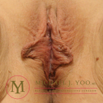 Labiaplasty Before & After Patient #2557