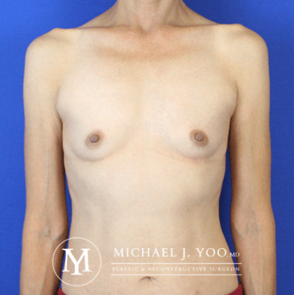 Breast Augmentation Before & After Patient #2563