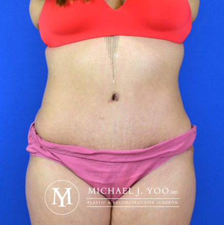 Tummy Tuck Before & After Patient #2582