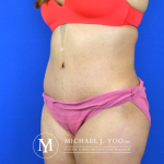 Tummy Tuck Before & After Patient #2582