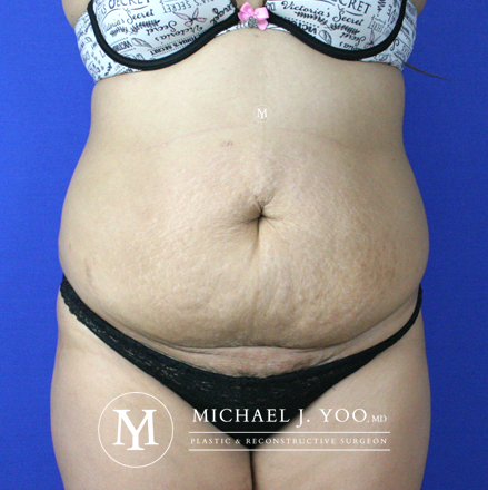 Tummy Tuck Before & After Patient #2582