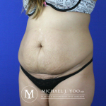 Tummy Tuck Before & After Patient #2582