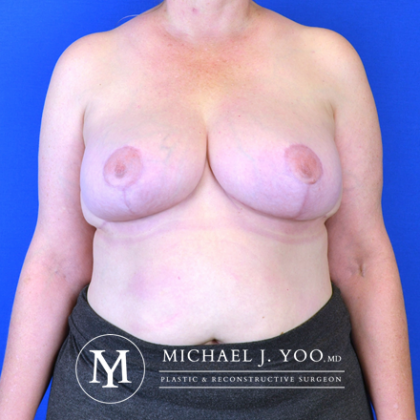 Breast Reduction Before & After Patient #2610