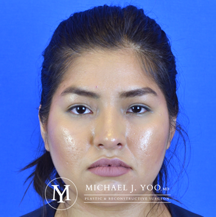 Rhinoplasty Before & After Patient #2615