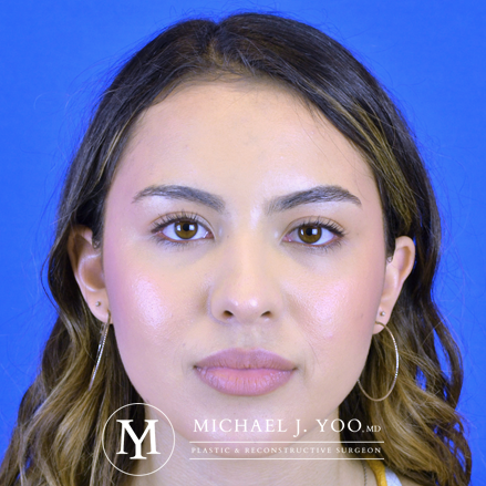 Rhinoplasty Before & After Patient #2621