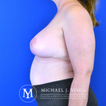 Breast Reduction Before & After Patient #2610