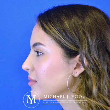 Rhinoplasty Before & After Patient #2621