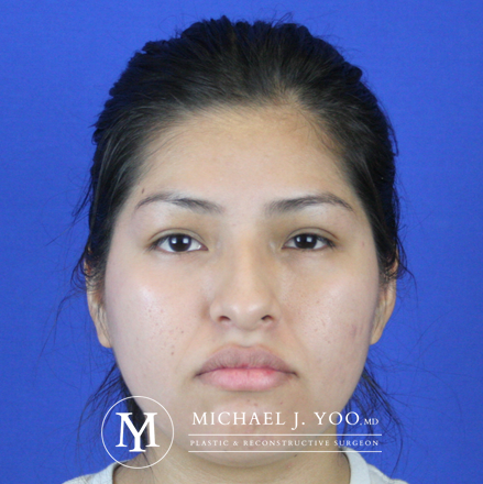 Rhinoplasty Before & After Patient #2615