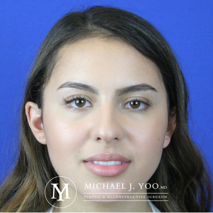 Rhinoplasty Before & After Patient #2621