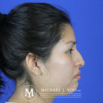 Rhinoplasty Before & After Patient #2615