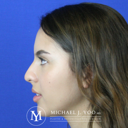 Rhinoplasty Before & After Patient #2621