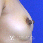 Nipple Reduction Before & After Patient #2668