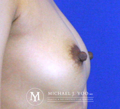 Nipple Reduction Before & After Patient #2668