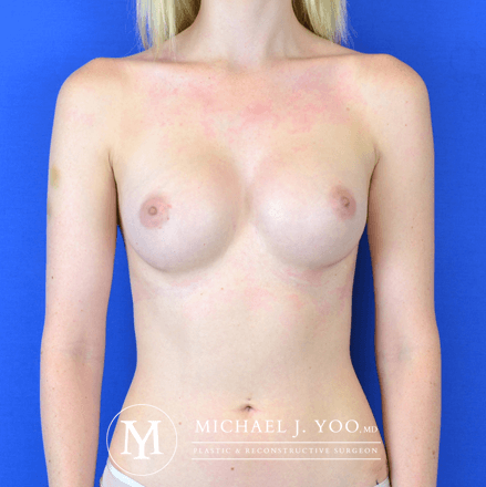 Breast Augmentation Before & After Patient #2764