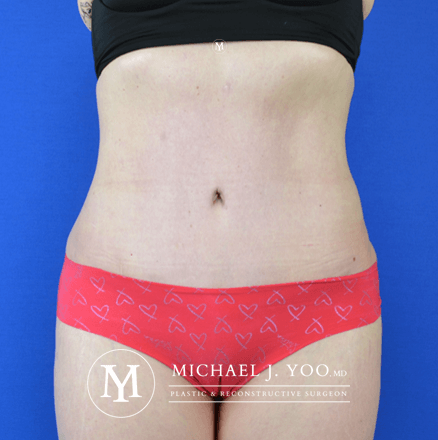 Tummy Tuck Before & After Patient #2689